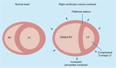 rv vs Lv failure